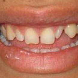Patient's mouth before cosmetic dentistry by Dental Associates, Inc.