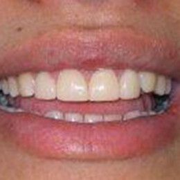 Patient's mouth after cosmetic dentistry by Dental Associates, Inc.