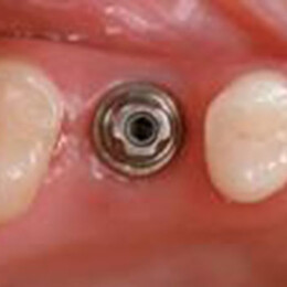 Implant by Dental Associates, Inc.