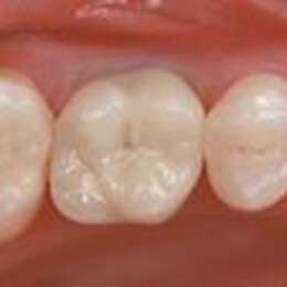 Dental crown by Dental Associates, Inc.