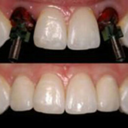 Dental veneers by Dental Associates, Inc.