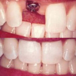 Dental implants by Dental Associates, Inc.