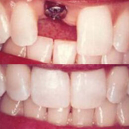 Dental implants by Dental Associates, Inc.