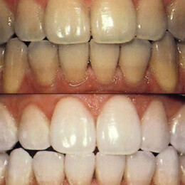 Teeth whitening by Dental Associates, Inc.